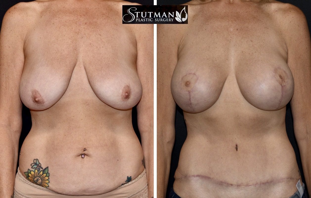 Before and After Image: Breast Lift and Abdominoplasty - front
