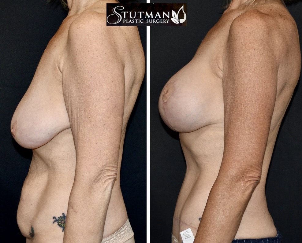 Before and After Image: Breast Lift and Abdominoplasty - left-side