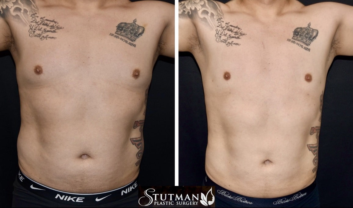 Before and After Image: Gynecomastia - front