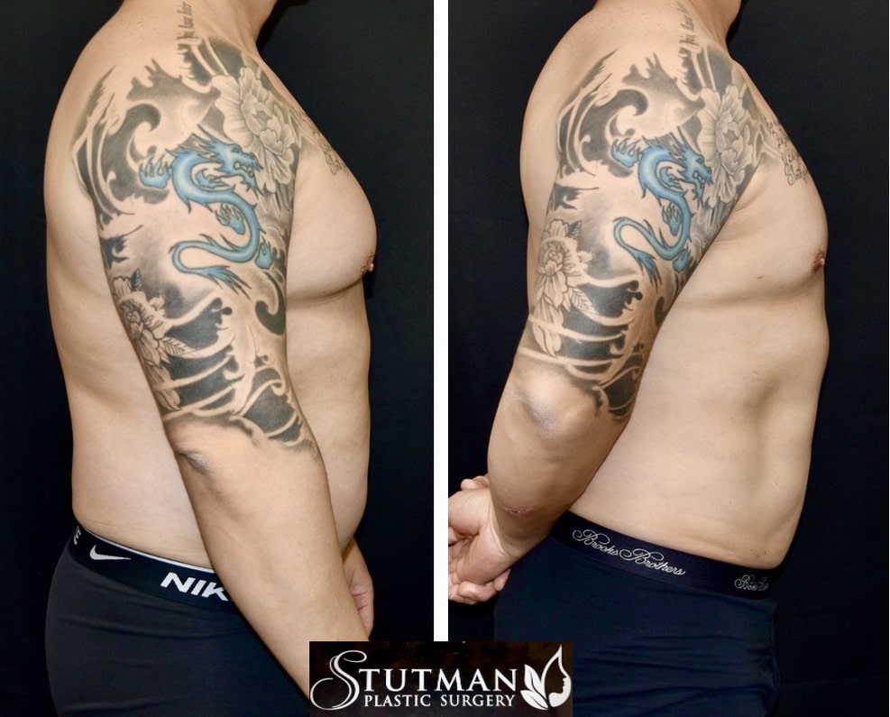 Before and After Image: Gynecomastia - right-side
