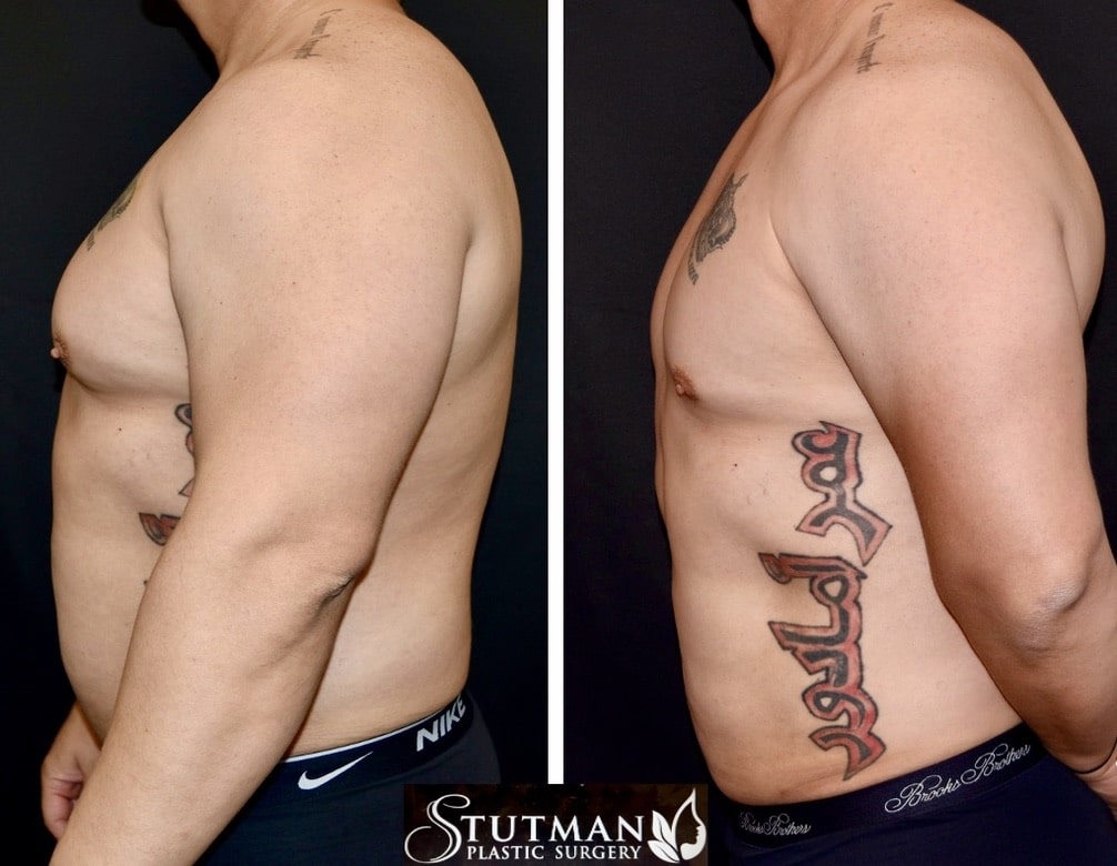 Before and After Image: Gynecomastia - left-side