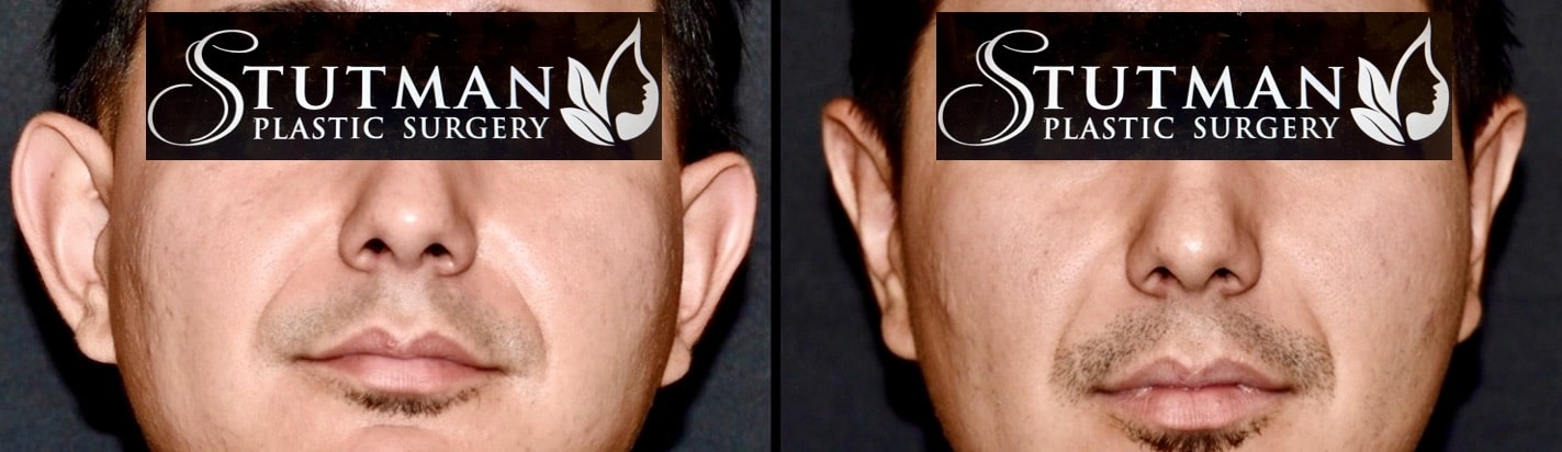 Before and After Image: Otoplasty (Ear Pinning) - front