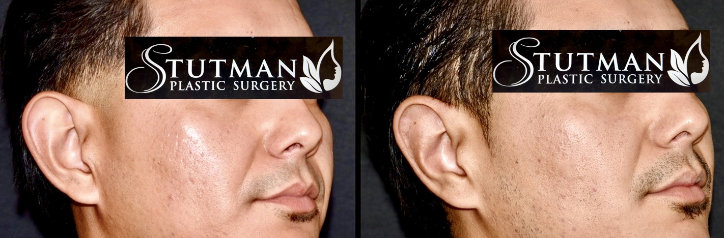 Before and After Image: Otoplasty (Ear Pinning) - right-front-oblique