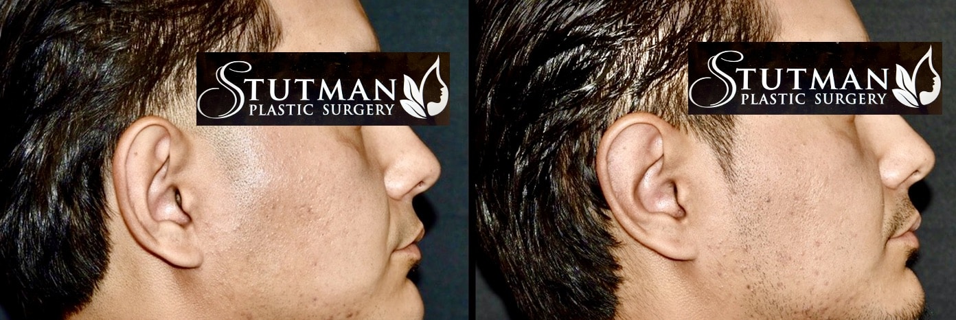 Before and After Image: Otoplasty (Ear Pinning) - right-side
