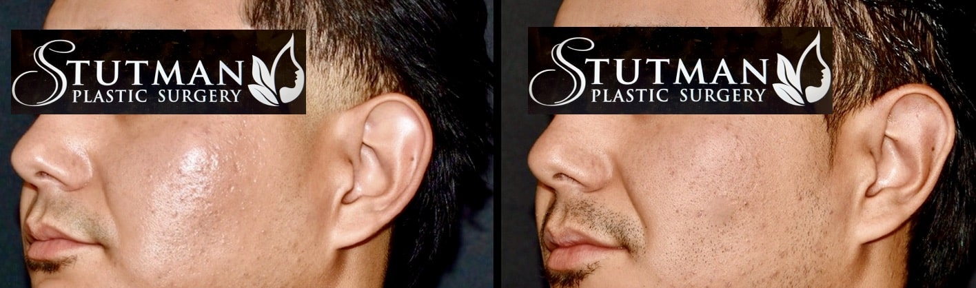 Before and After Image: Otoplasty (Ear Pinning) - left-front-oblique