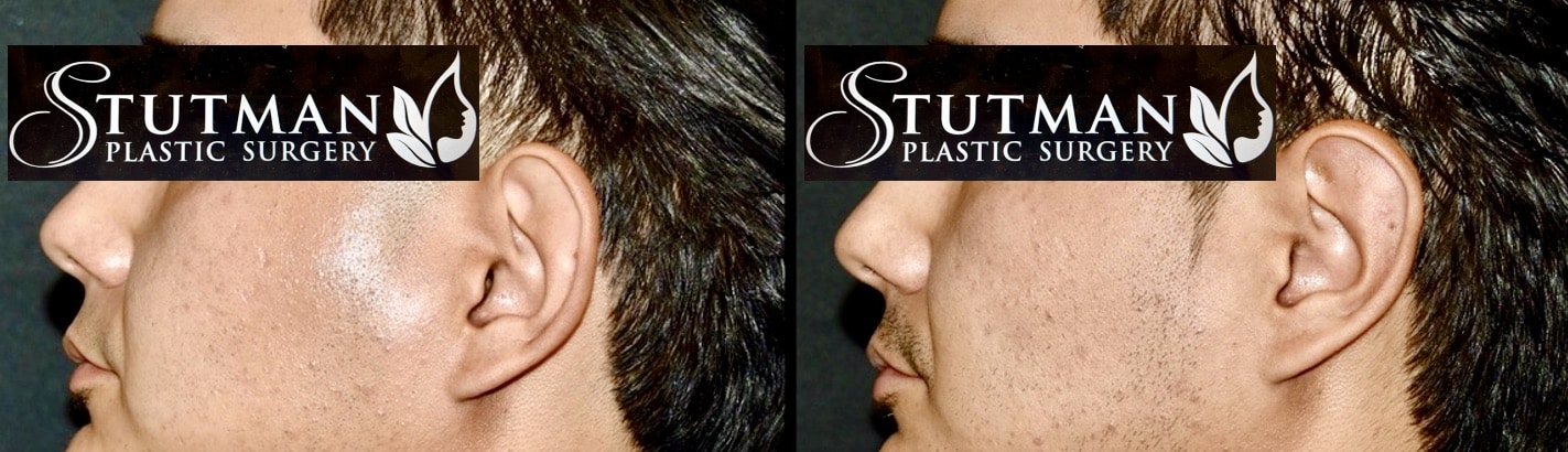 Before and After Image: Otoplasty (Ear Pinning) - left-side