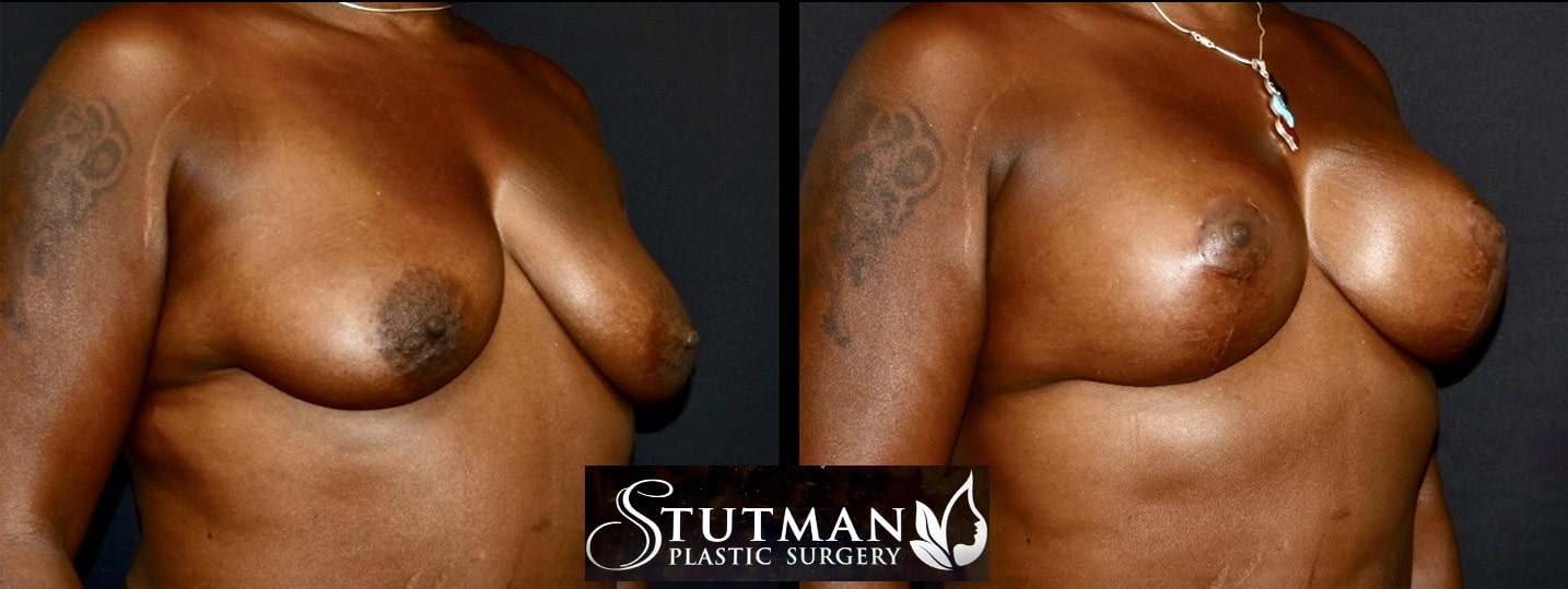 Before and After Image: Breast Lift - right-front-oblique