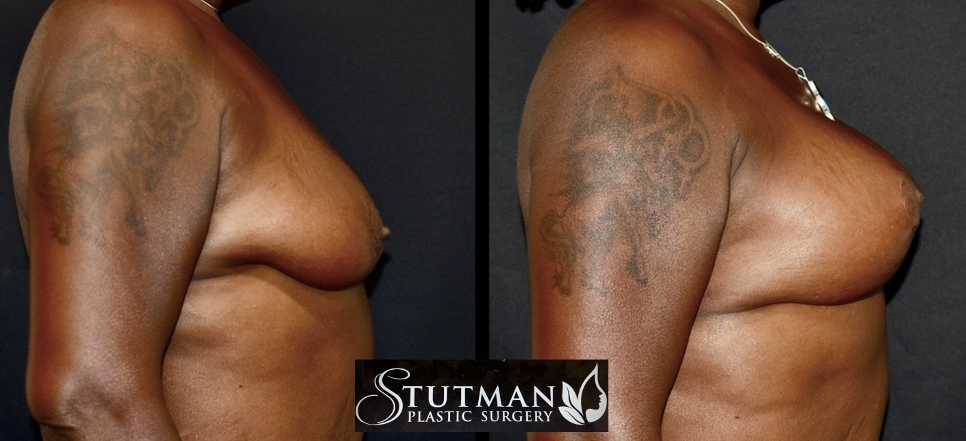 Before and After Image: Breast Lift - right-side