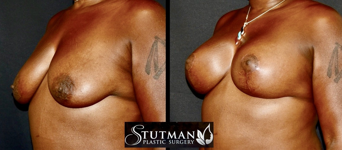 Before and After Image: Breast Lift - left-front-oblique