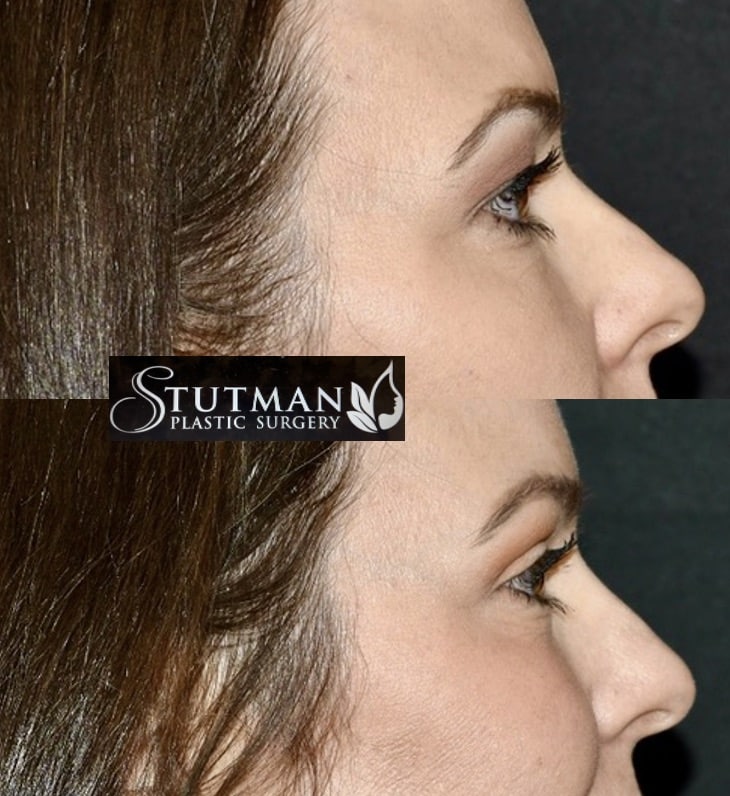 Before and After Image: Blepharoplasty - right-side