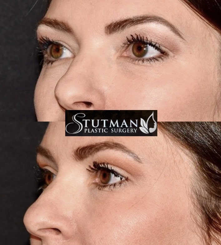 Before and After Image: Blepharoplasty - left-front-oblique