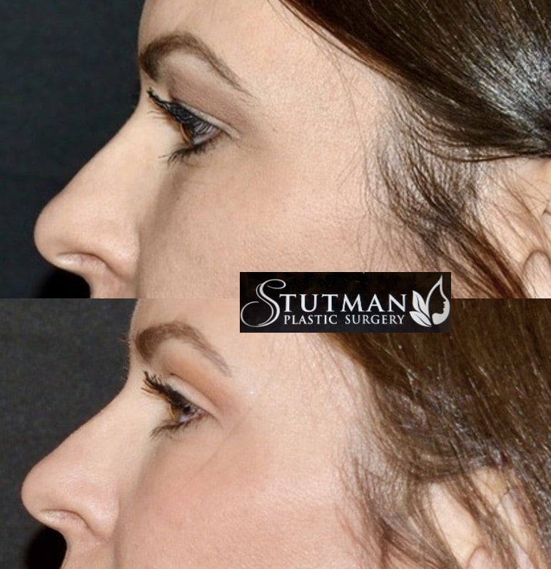 Before and After Image: Blepharoplasty - left-side