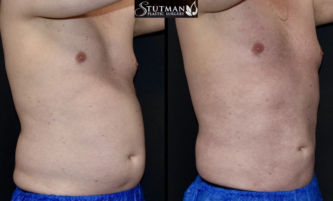 Before and After Image: High-Def Liposuction - right-front-oblique