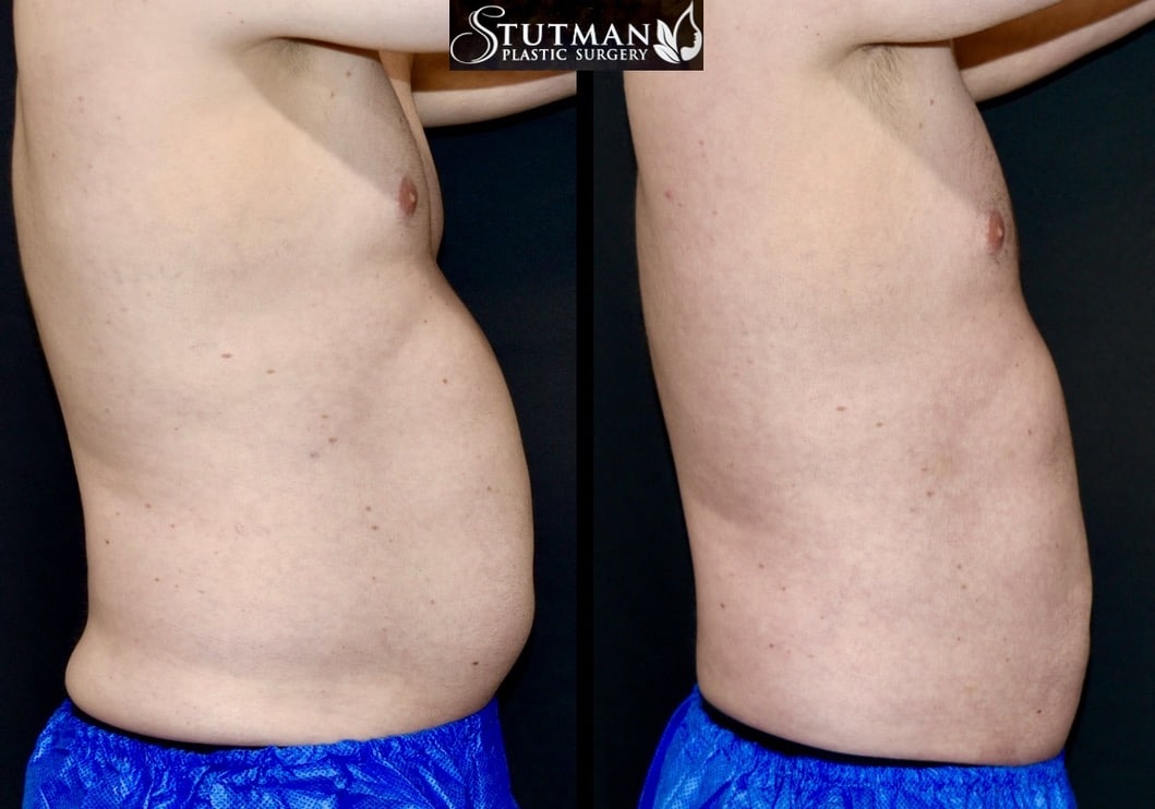 Before and After Image: High-Def Liposuction - right-side