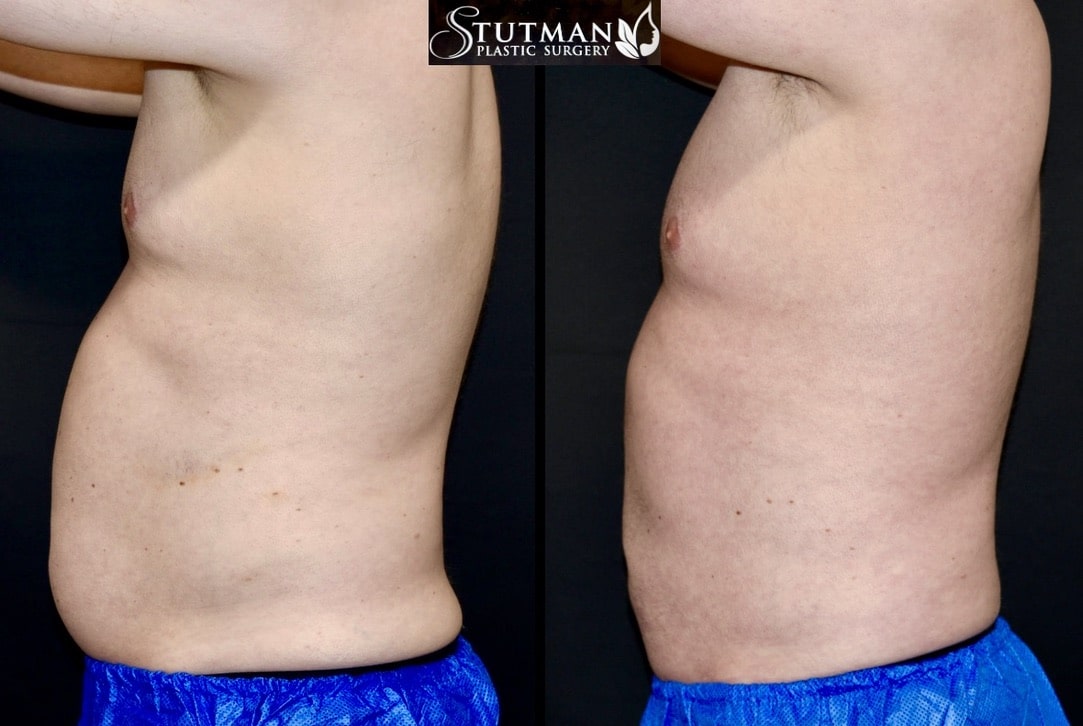 Before and After Image: High-Def Liposuction - left-side