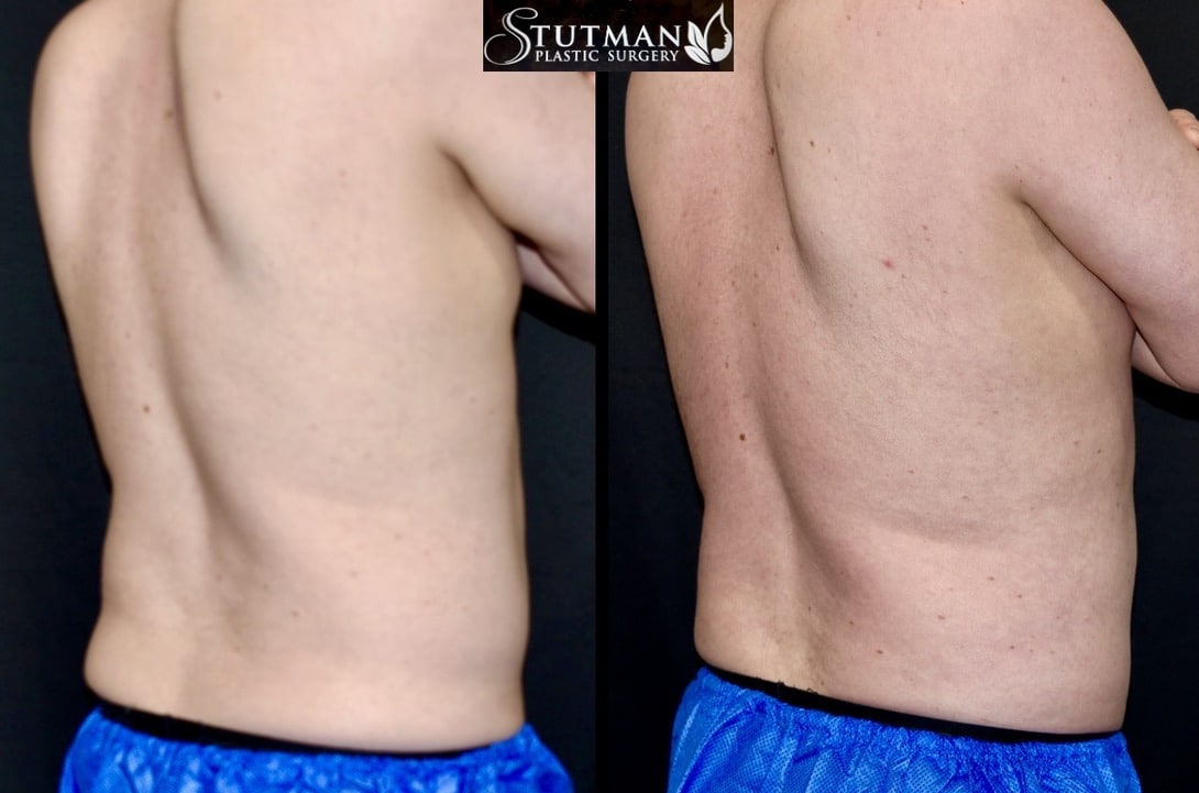 Before and After Image: High-Def Liposuction - right-back-oblique