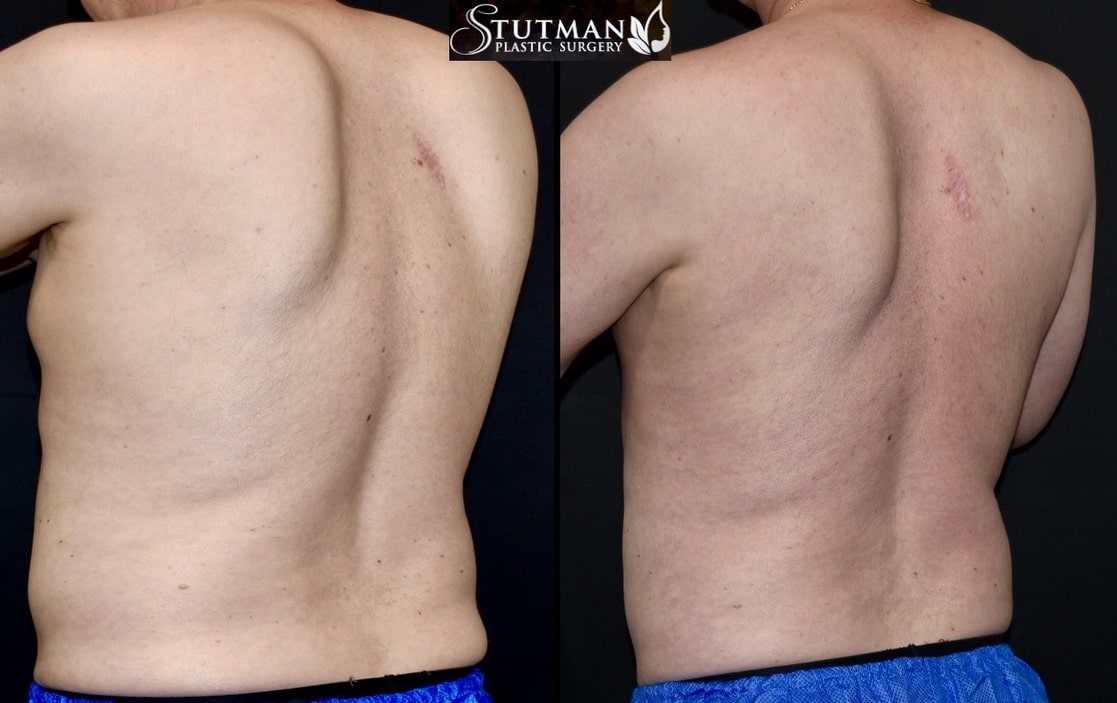 Before and After Image: High-Def Liposuction - left-back-oblique
