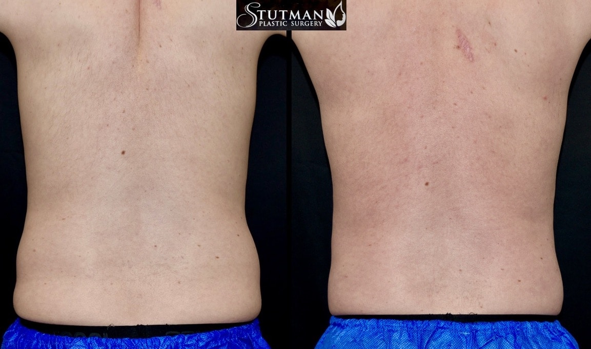 Before and After Image: High-Def Liposuction - back