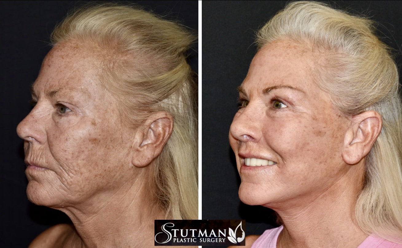 Before and After Image: Facelift/Necklift - left-front-oblique