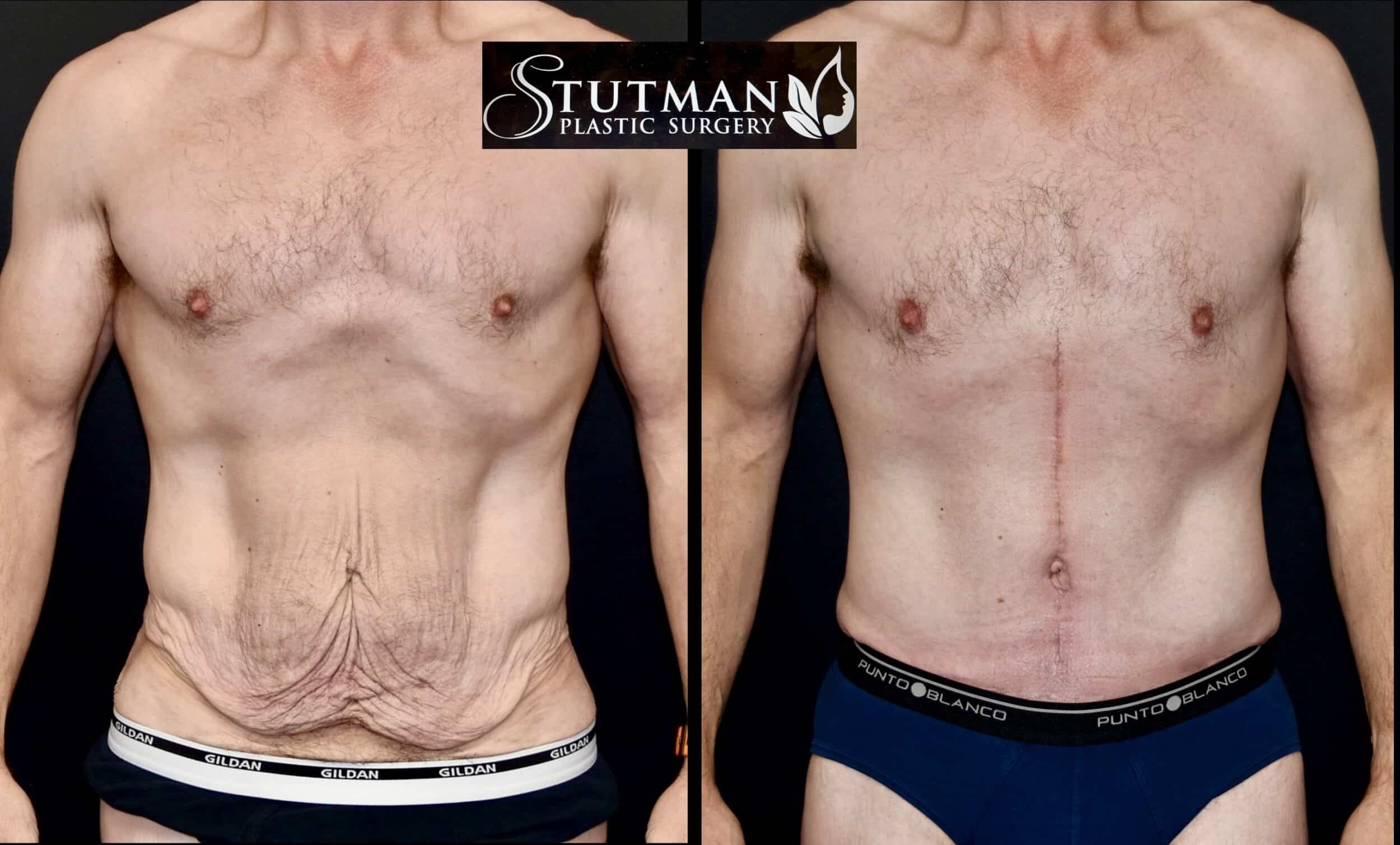 Before and After Image: Tummy Tuck - front