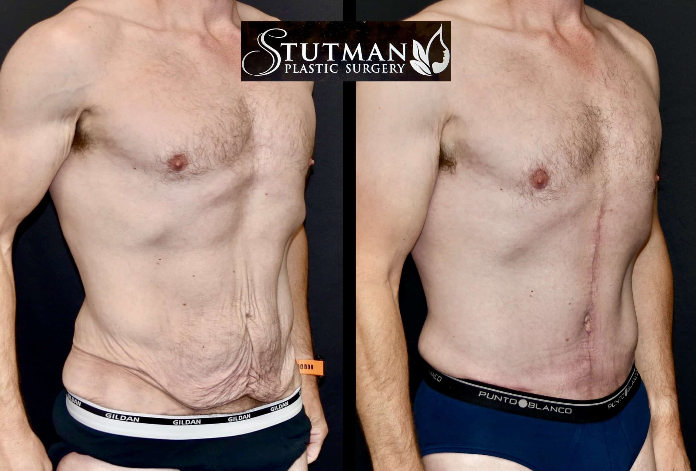 Before and After Image: Tummy Tuck - right-front-oblique
