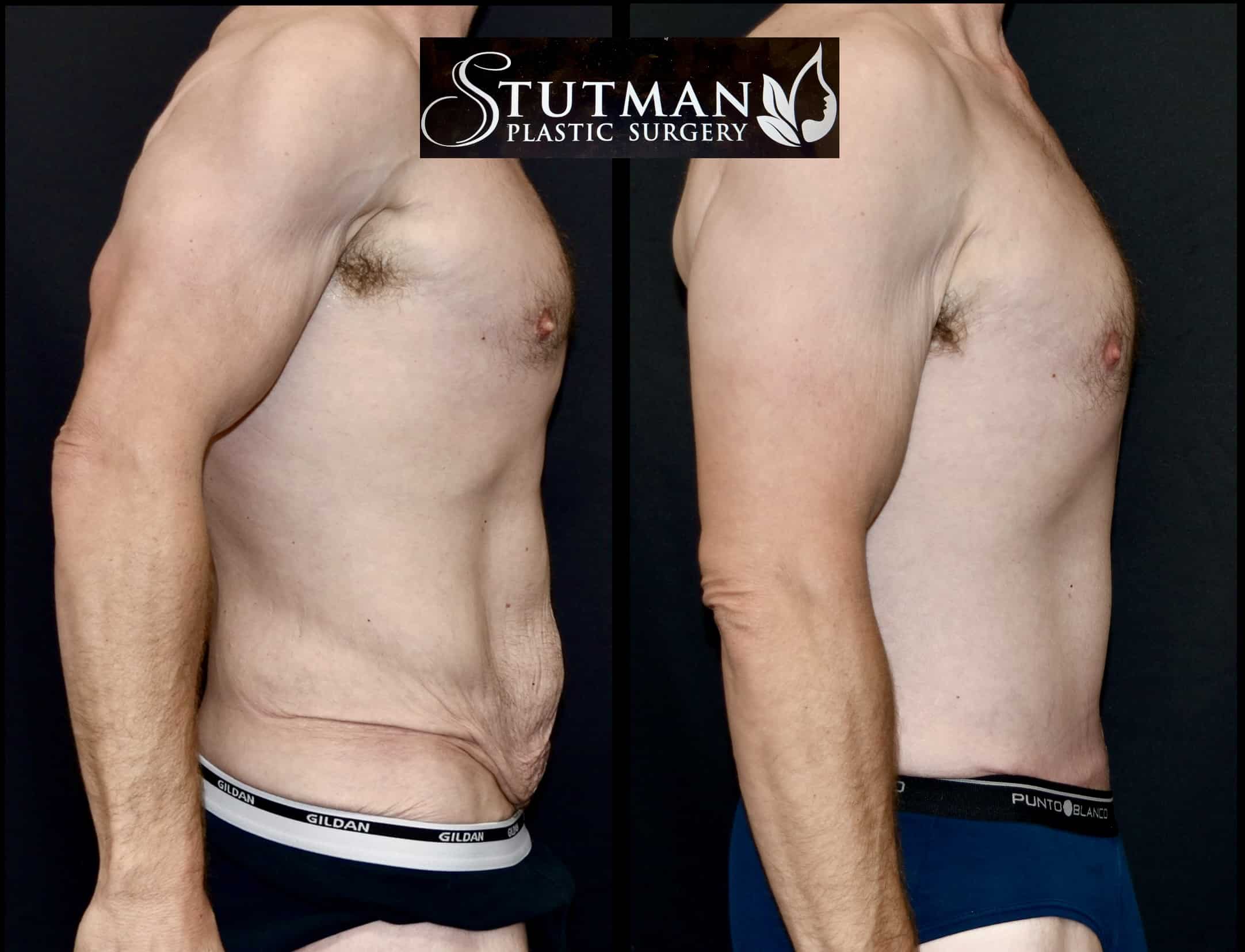 Before and After Image: Tummy Tuck - right-side