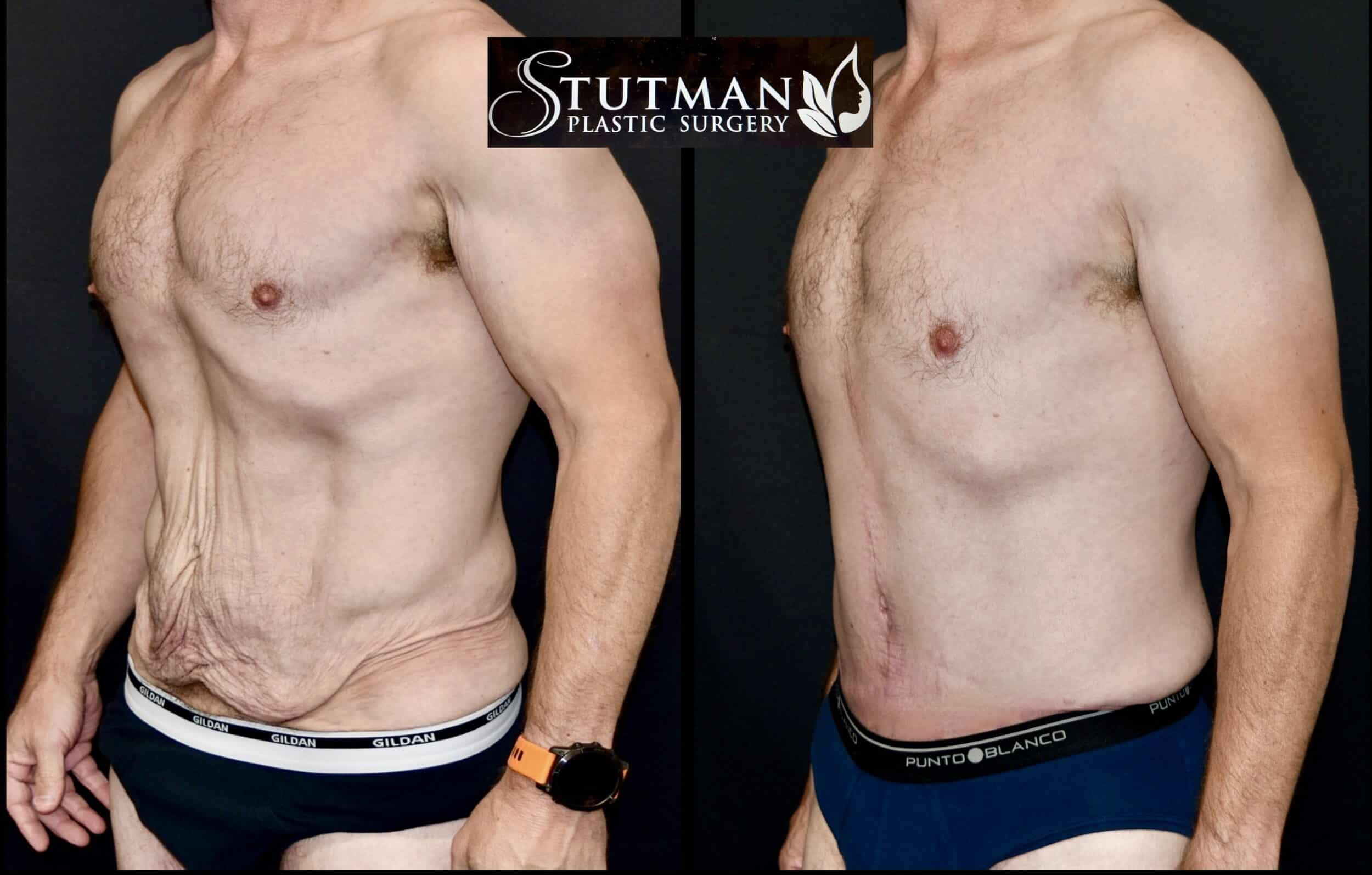 Before and After Image: Tummy Tuck - left-front-oblique