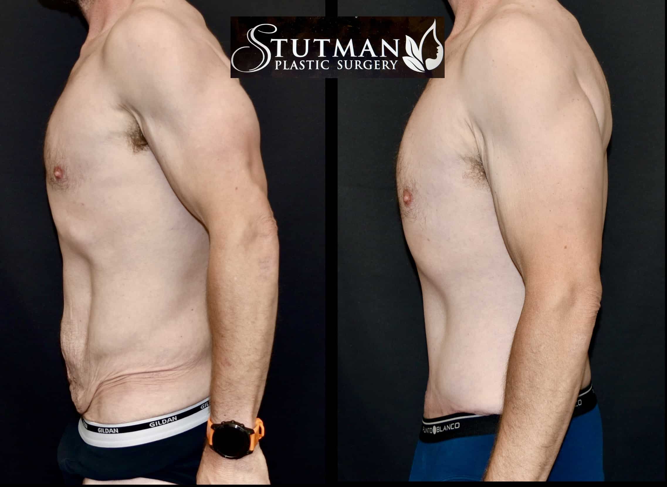 Before and After Image: Tummy Tuck - left-side