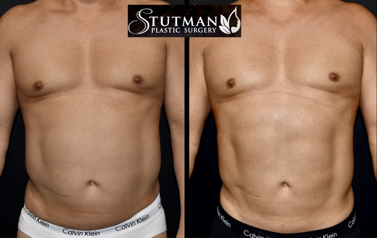 Before and After Image: S.L.A.E. Liposuction - front