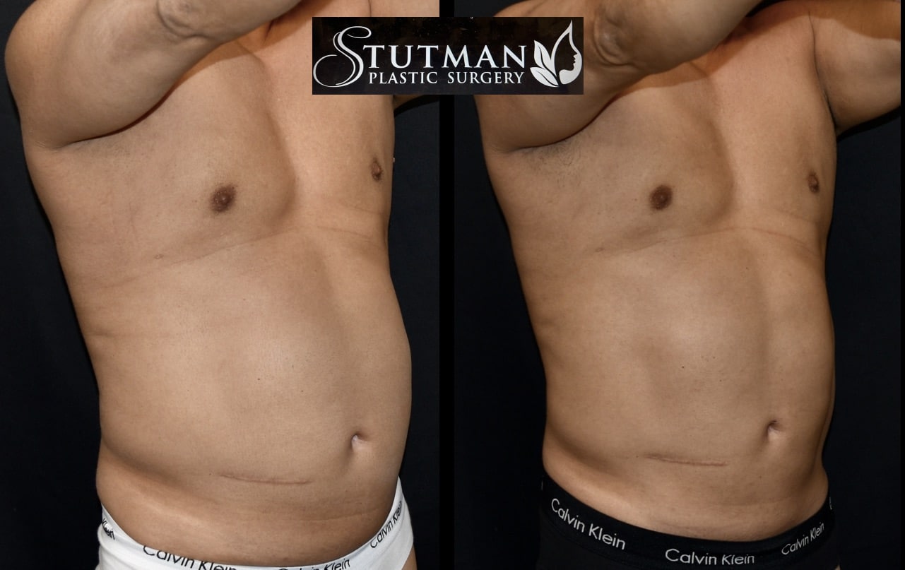 Before and After Image: S.L.A.E. Liposuction - right-front-oblique