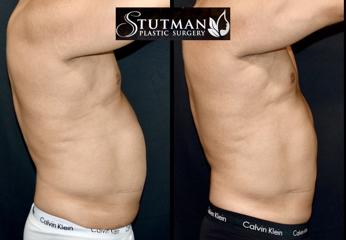 Before and After Image: S.L.A.E. Liposuction - right-side