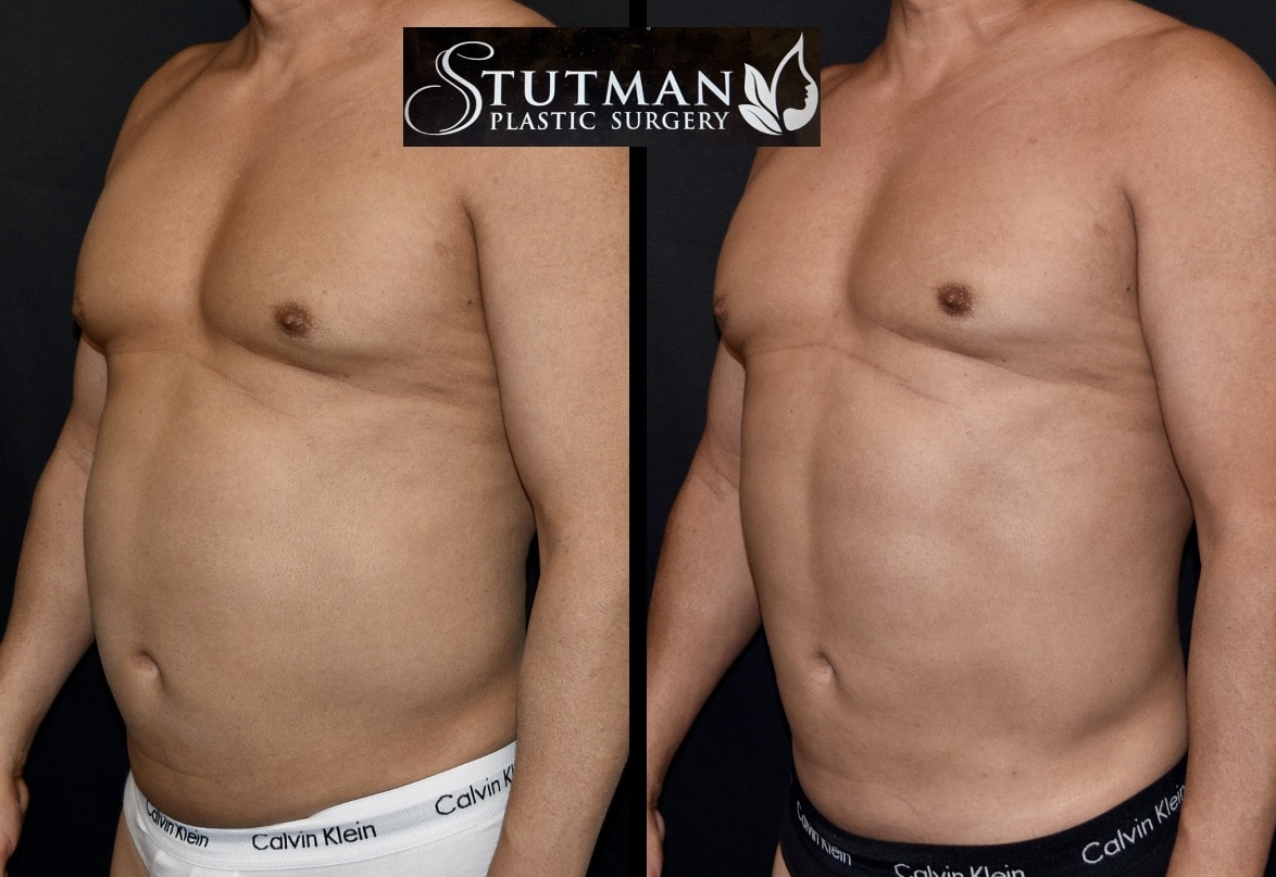 Before and After Image: S.L.A.E. Liposuction - left-front-oblique