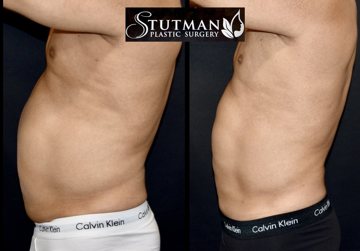 Before and After Image: S.L.A.E. Liposuction - left-side