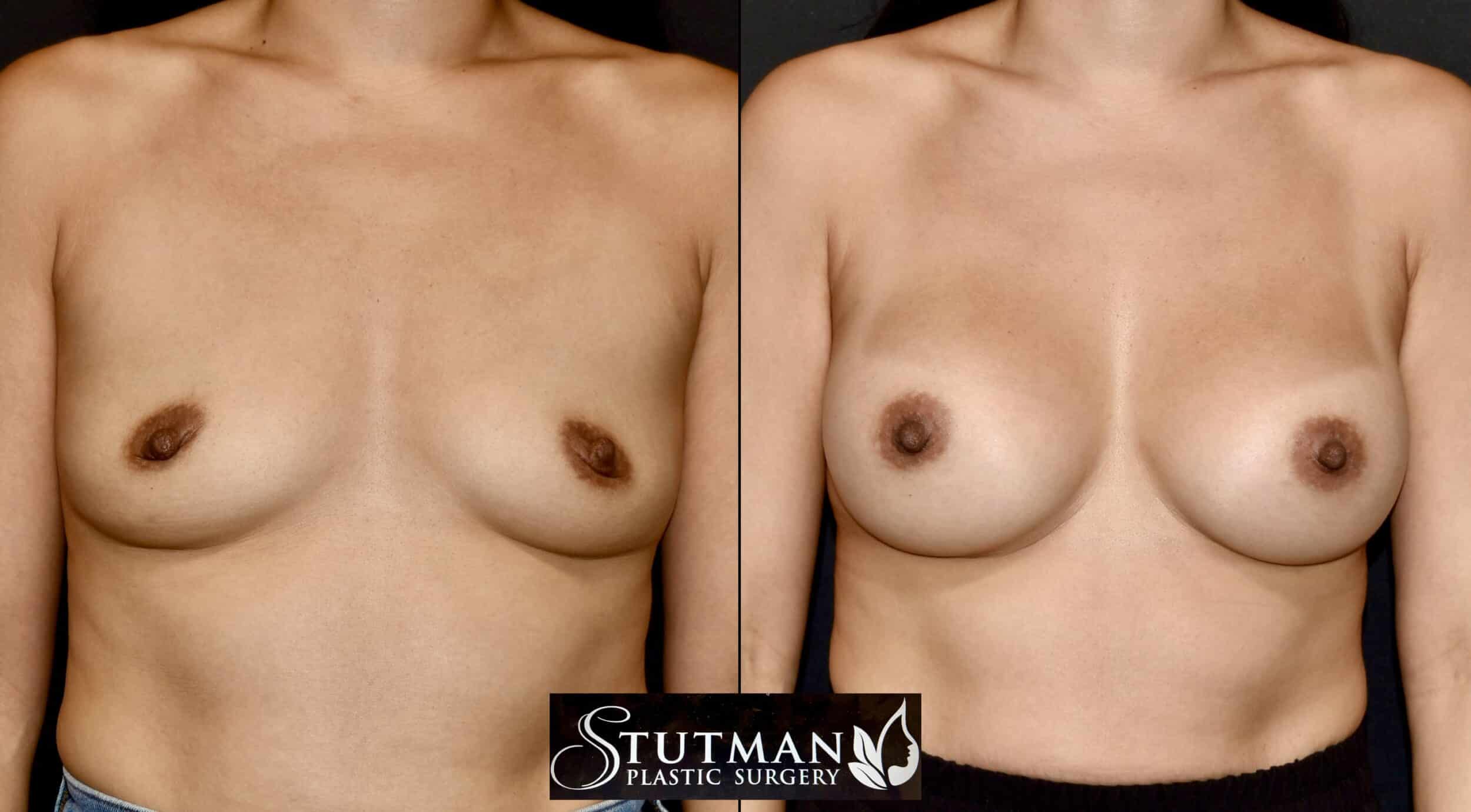 Before and After Image: Breast Augmentation - front