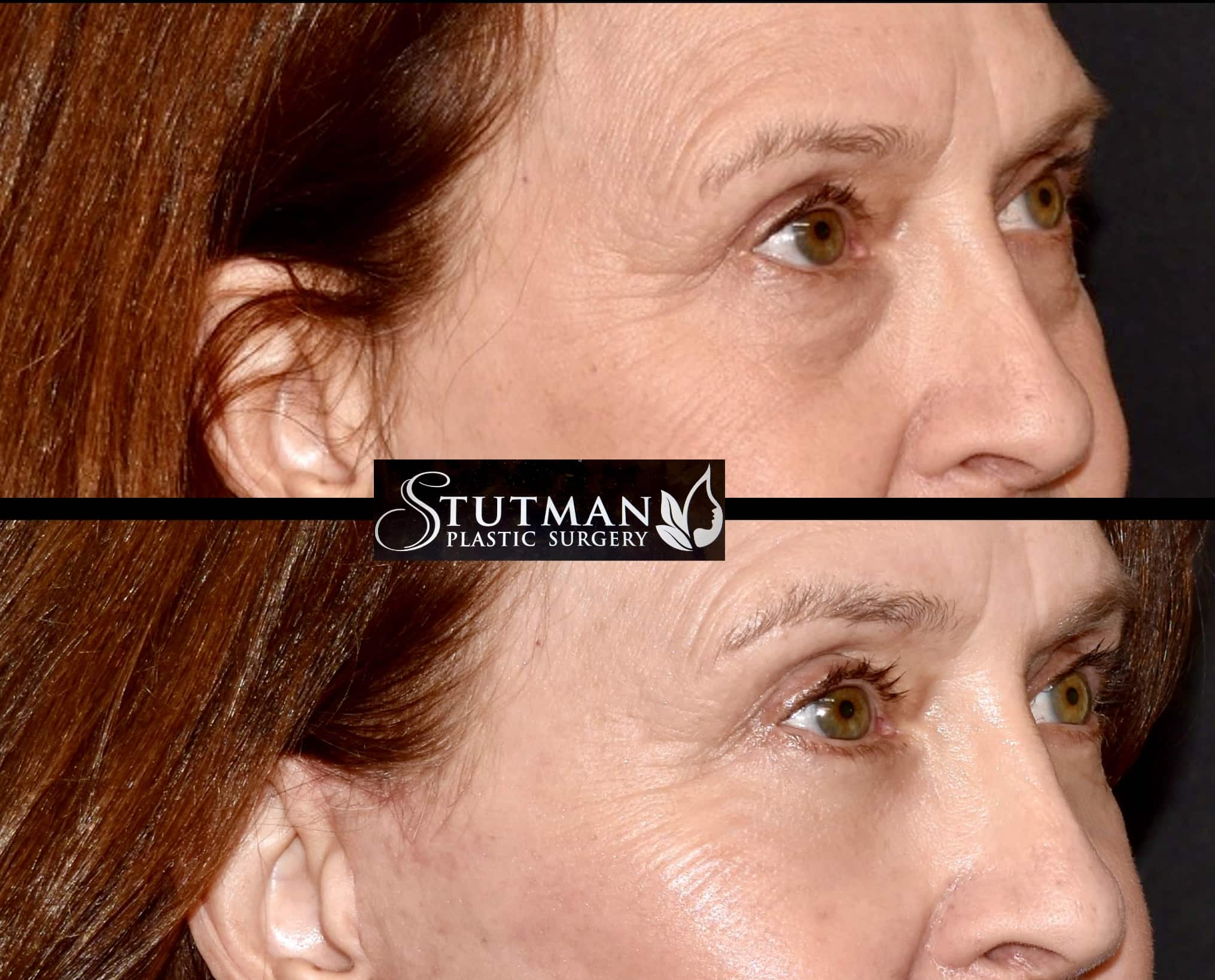 Before and After Image: Blepharoplasty - right-front-oblique