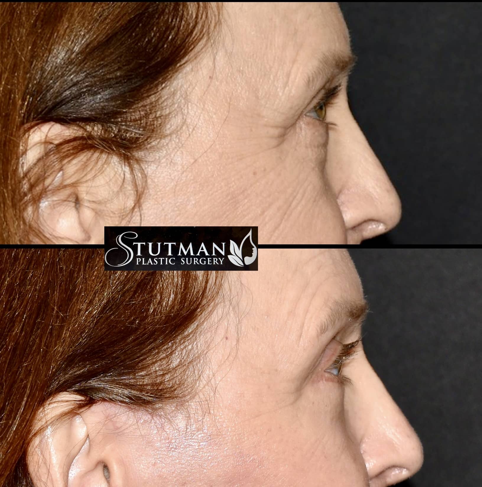 Before and After Image: Blepharoplasty - right-side