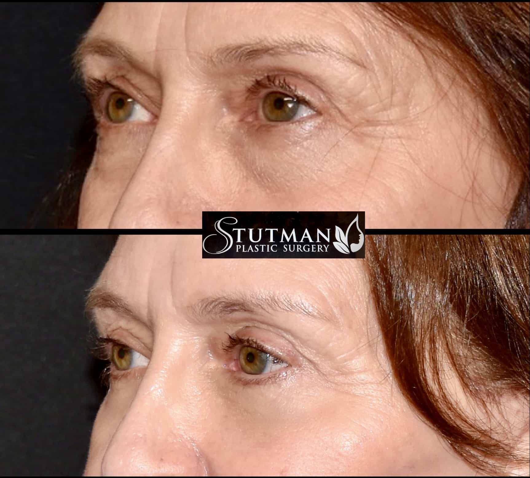 Before and After Image: Blepharoplasty - left-front-oblique