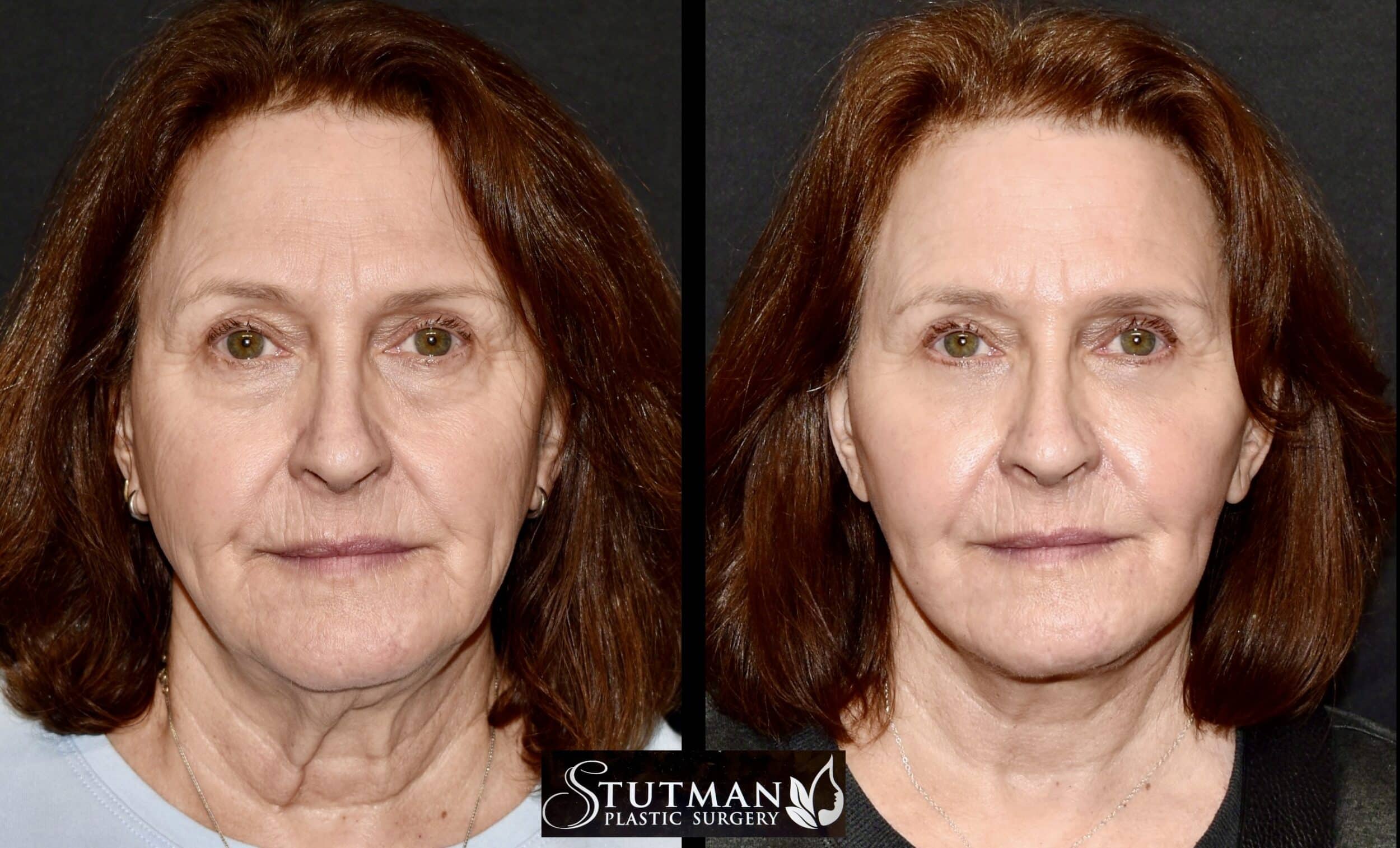 Before and After Image: Facelift/Necklift