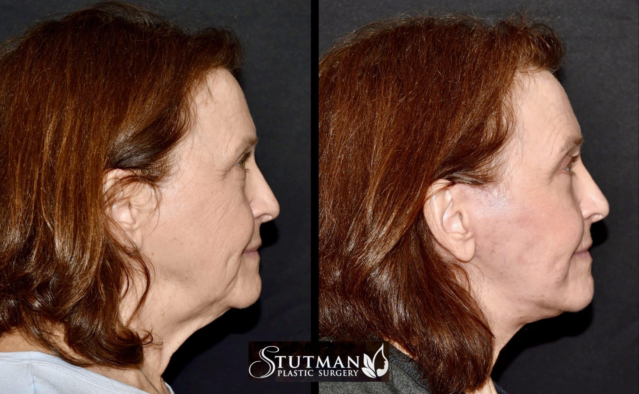 Before and After Image: Facelift/Necklift - right-side