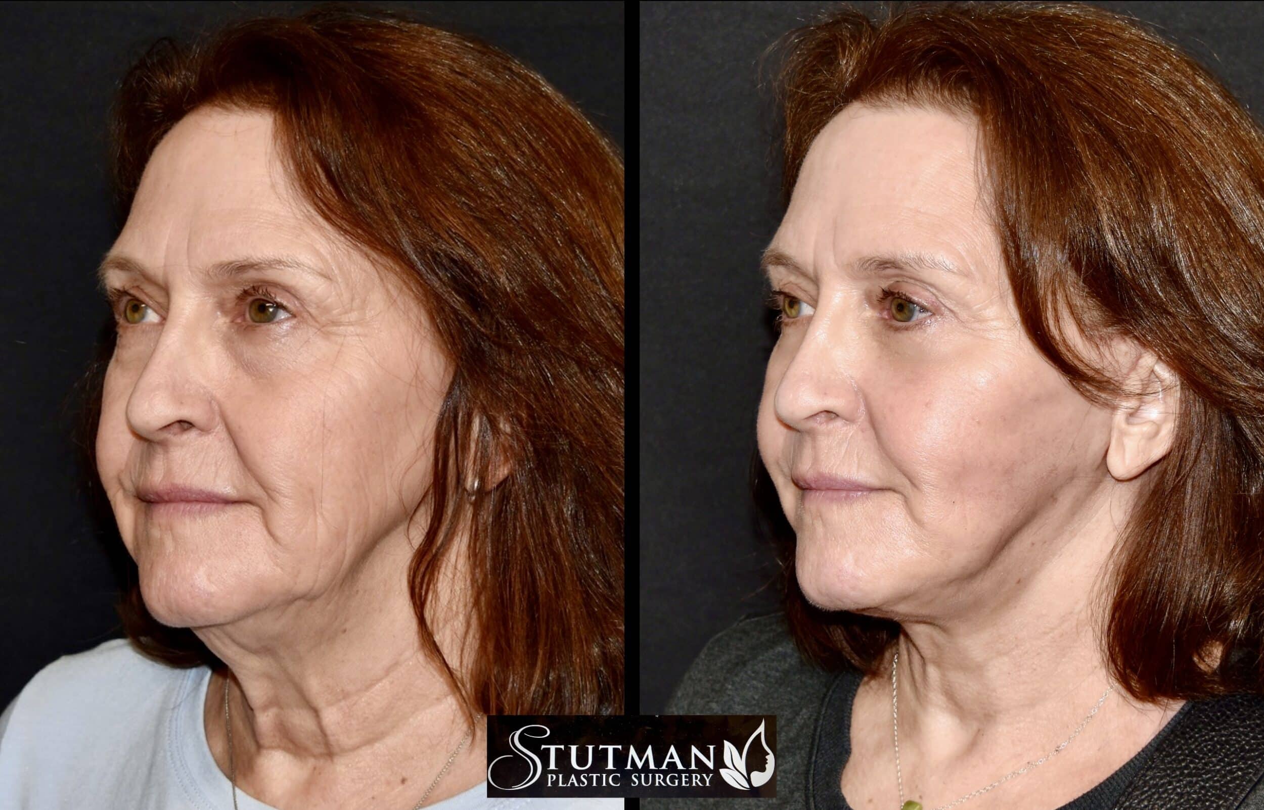 Before and After Image: Facelift/Necklift - left-front-oblique