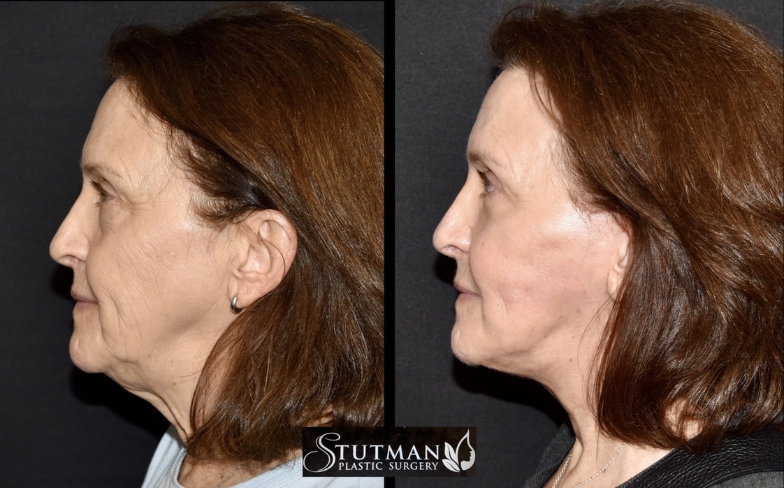 Before and After Image: Facelift/Necklift - left-side