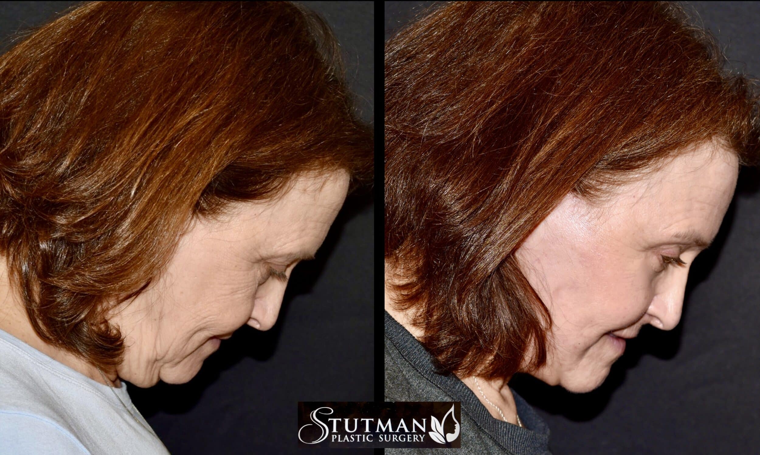 Before and After Image: Facelift/Necklift - right-side