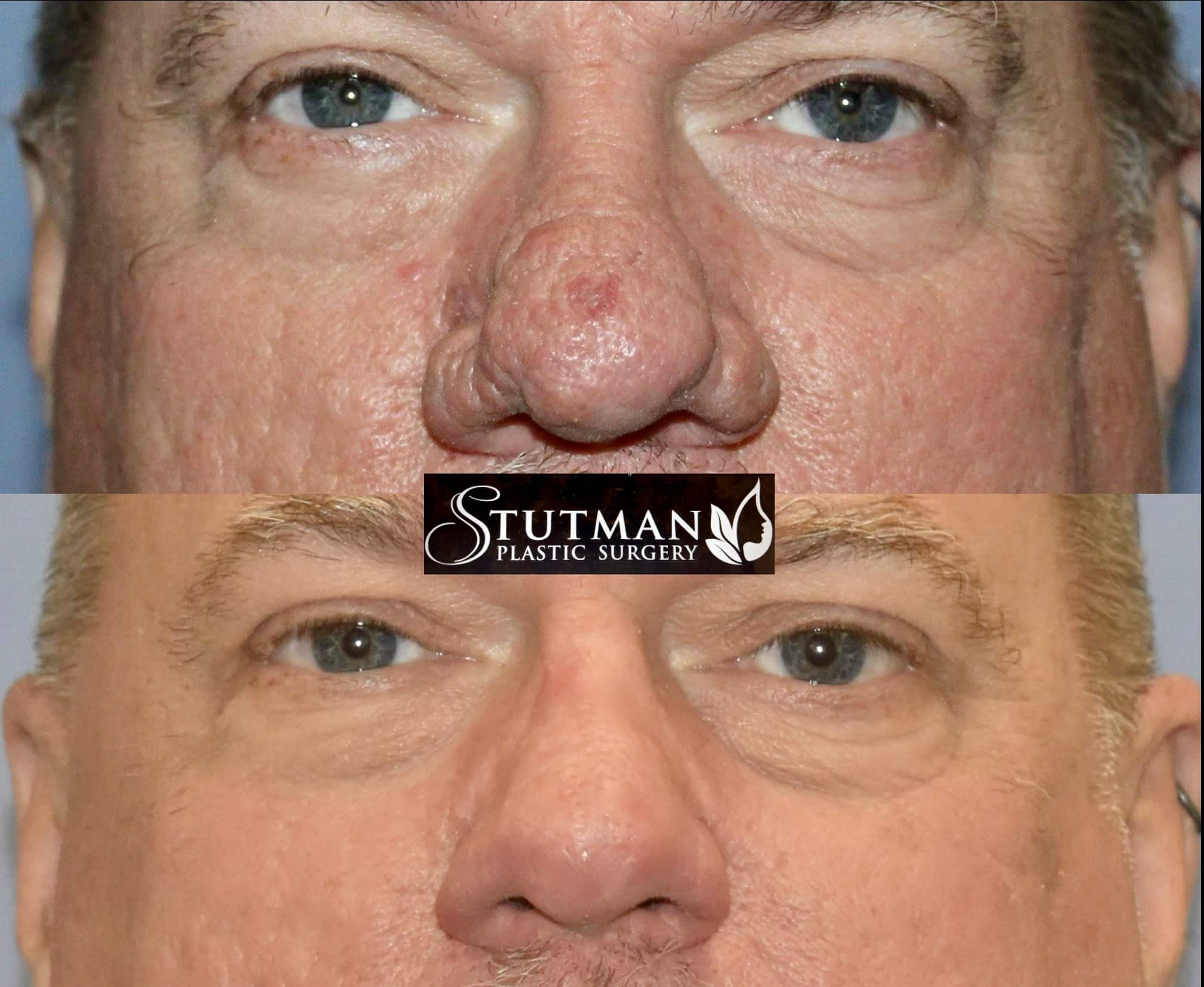 Before and After Image: Rhinoplasty