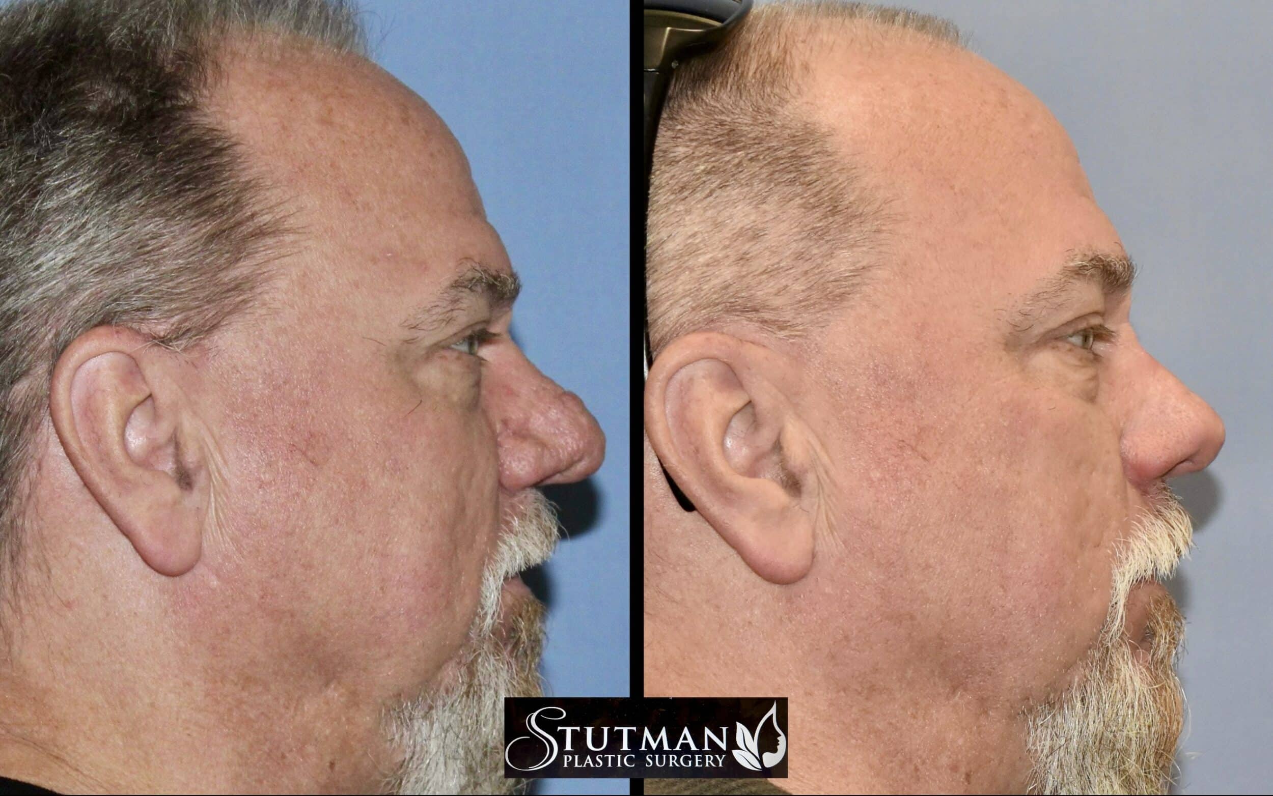 Before and After Image: Rhinoplasty - right-side