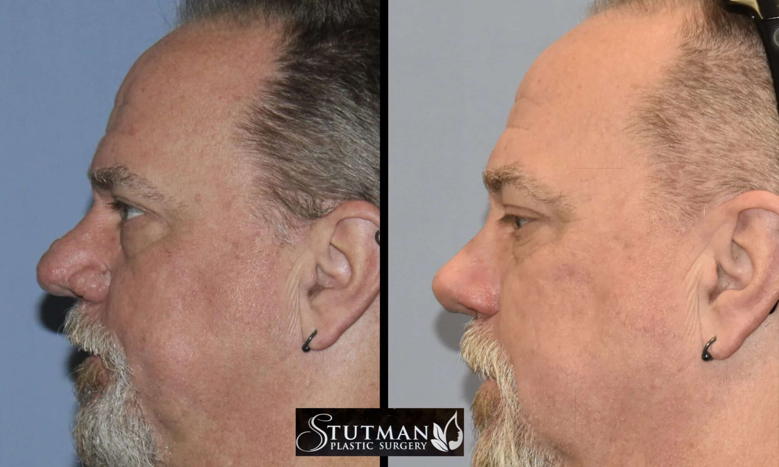 Before and After Image: Rhinoplasty - left-side