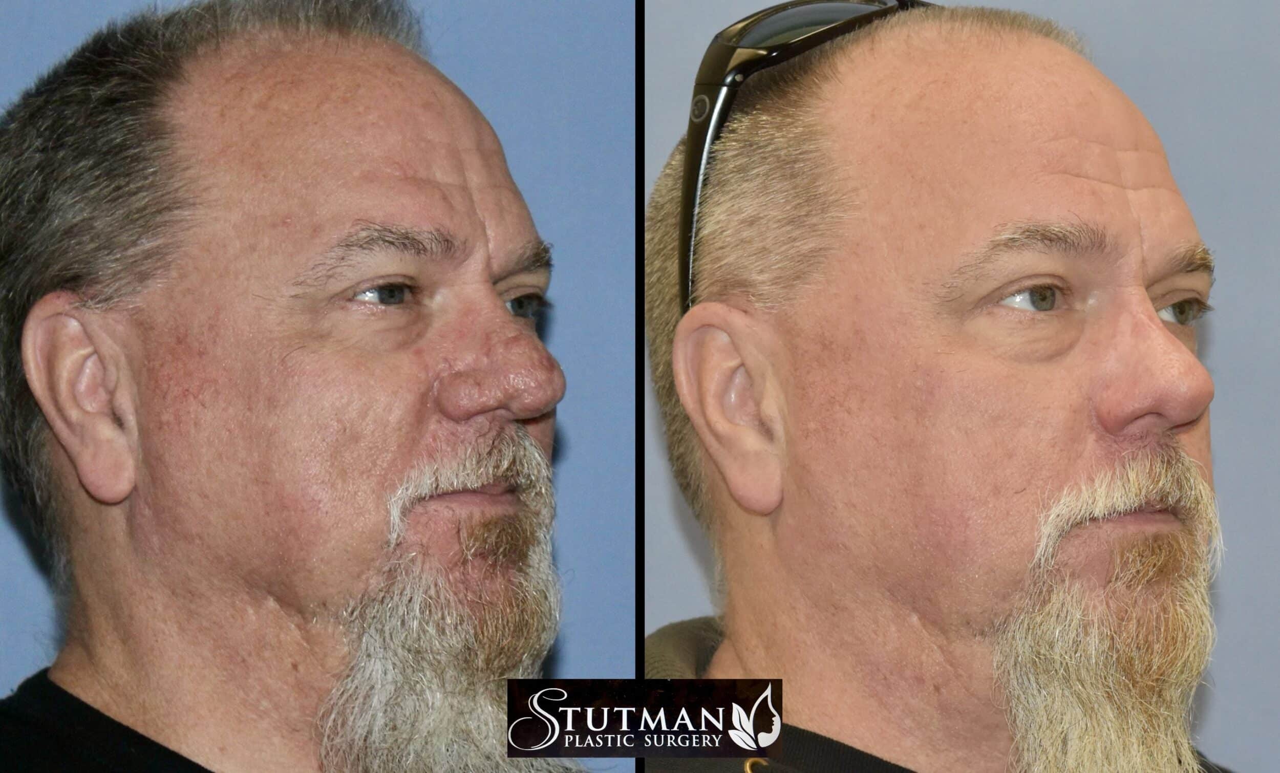 Before and After Image: Rhinoplasty - right-front-oblique