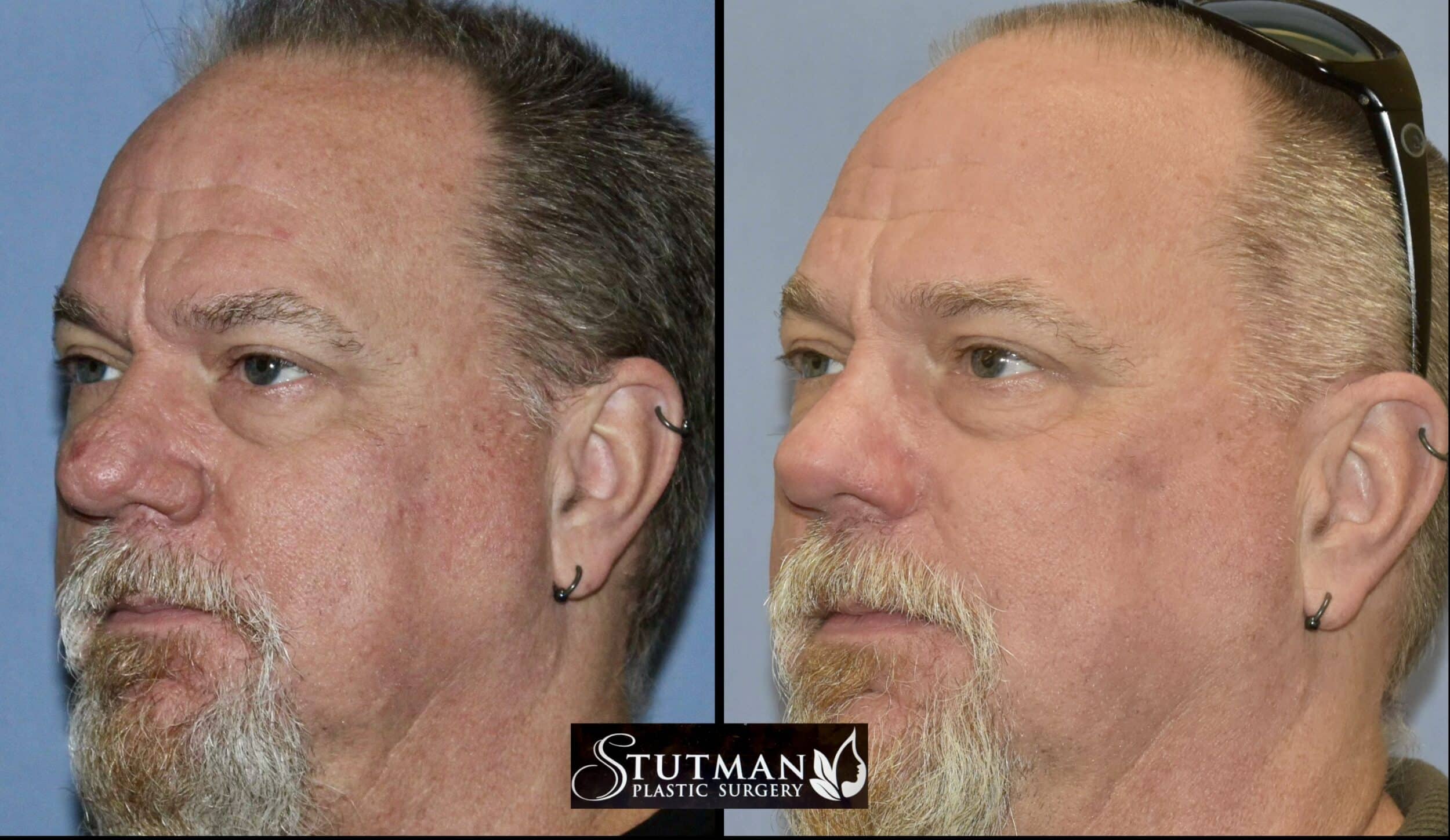 Before and After Image: Rhinoplasty - left-front-oblique