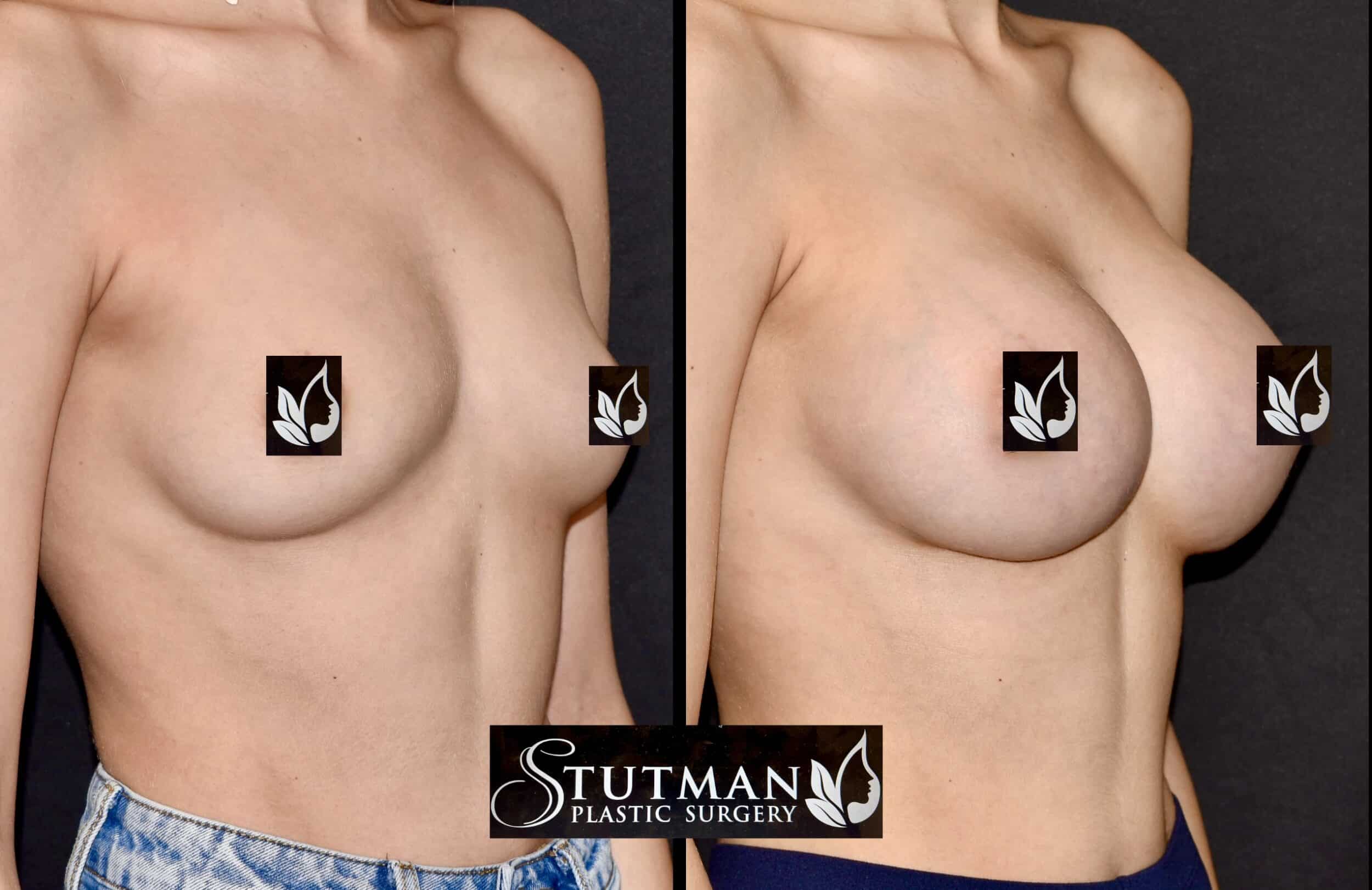 Before and After Image: Breast Augmentation - right-front-oblique