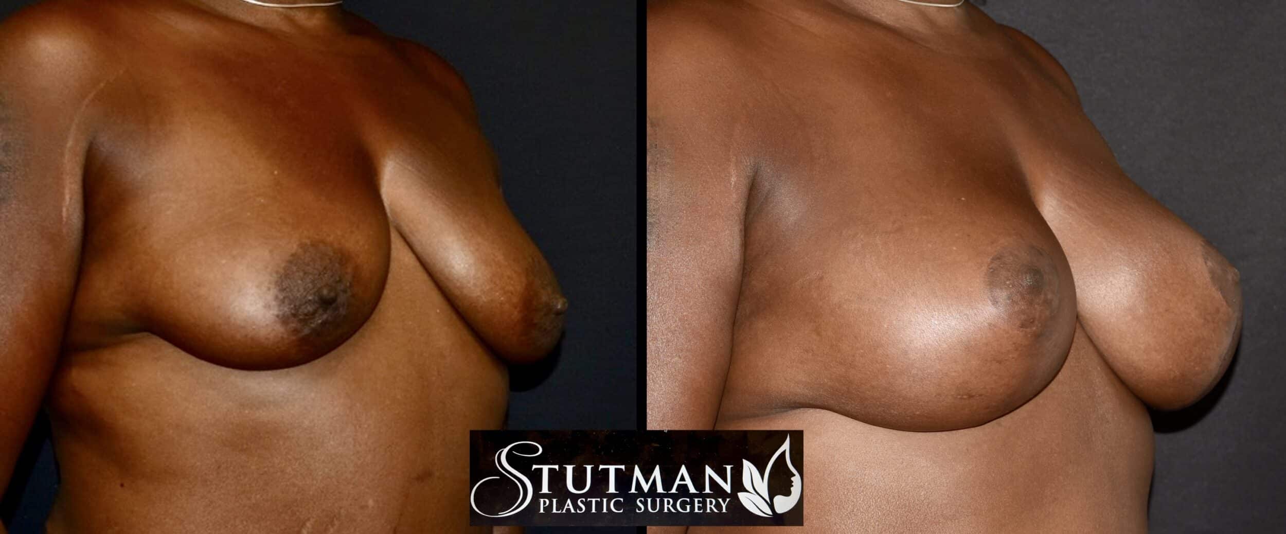 Before and After Image: Breast Lift - right-front-oblique