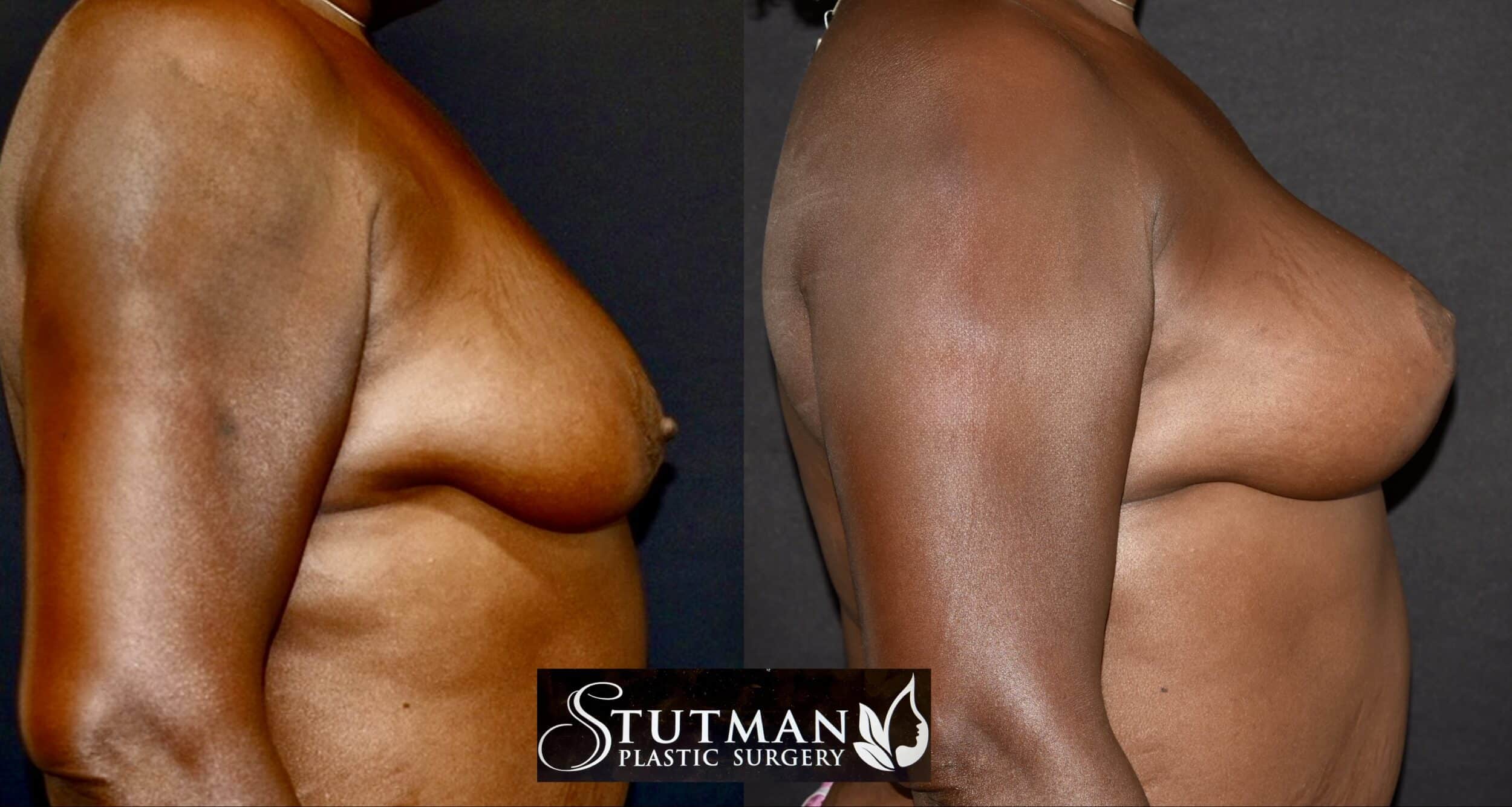 Before and After Image: Breast Lift - right-side
